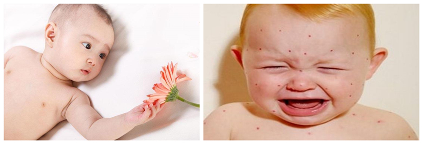 兒童濕疹反反復(fù)復(fù)，您有在家安裝家用除濕產(chǎn)品嗎？